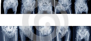 x-ray of pelvis and hips joint different types of fractures Medical image concept