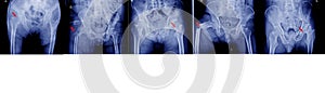 x-ray of pelvis and hips joint different types of fractures Medical image concept