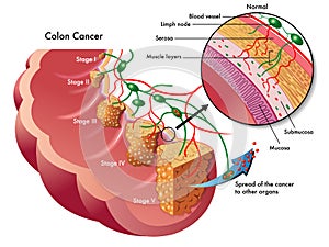 Colon cancer