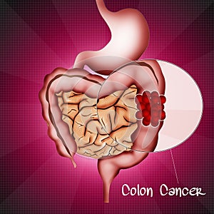 Colon cancer