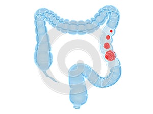 Colon cancer