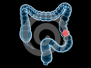 Colon cancer