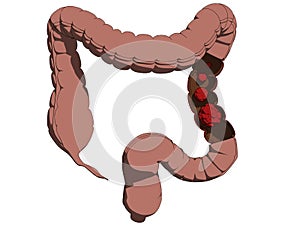 Colon cancer