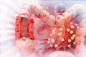 Colon cancer. Cancer attacking cell