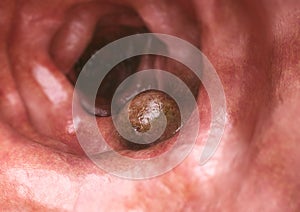 Colon cancer closeup - 3D Rendering photo