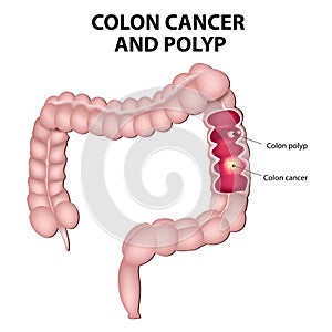 Colon cancer and colon polyps photo