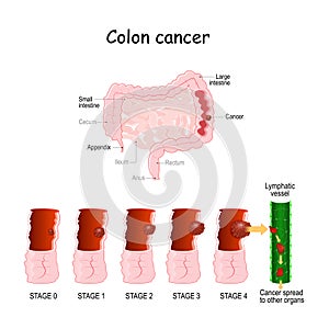 Colon cancer. Colorectal oncology. Stages of Development a malignant tumor