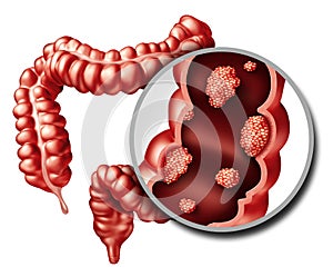 Colon Cancer Concept