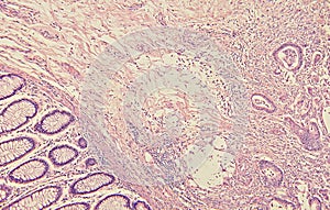 Colon Cancer Histology