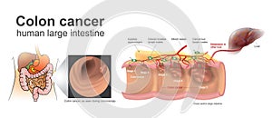 Colon Cancer human large intestine. Anatomy Illustration, art.