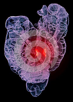 Colon cancer illustration, CT colonography