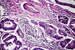 Colon cancer, light micrograph