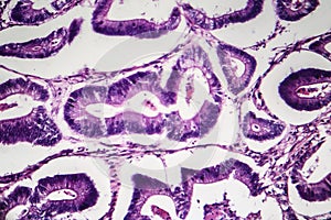 Colon cancer, light micrograph