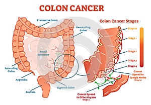 Colon cancer medical vector illustration scheme, anatomical diagram with cancer stages