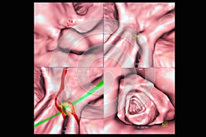 Colon cancer screening photo