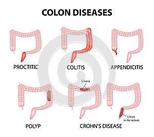 Colon diseases. Proctitis, colitis, appendicitis, polyp, ulcer, Crohn`s disease. Infographics. Vector illustration photo