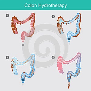 Colon Hydrotherapy..The secreted of waste that accumulates in the colon wall for a long time.