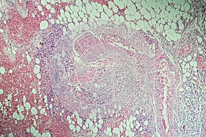 Colon inflammation in Crohn`s disease photo