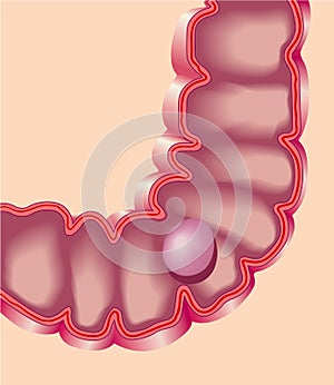 Colon polyp