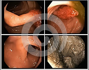 Colon Polyp: Endoscope inside colonoscopy for Colon polyps search. Colon cancer
