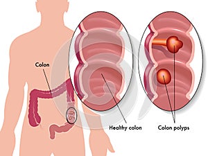 Colon polyps photo