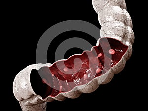 Colon polyps. 3d illustration, Polyp in the intestine.