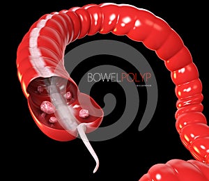Colon polyps. 3d illustration- Polyp in the intestine. black