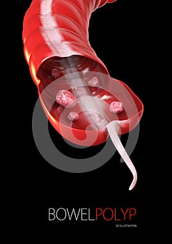 Colon polyps. 3d illustration- Polyp in the intestine. black