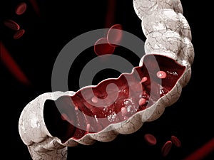 Colon polyps. 3d illustration, Polyp in the intestine.