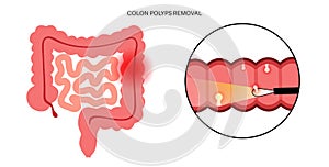 Colon polyps inflammation