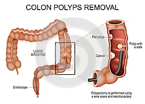 Colon polyps removal. Colonoscopy and Polypectomy