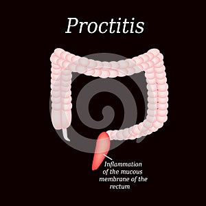 Colon. Proctitis. Vector illustration photo