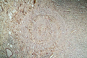 Colon tissue with diverticulum