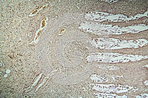 Colon tissue with diverticulum