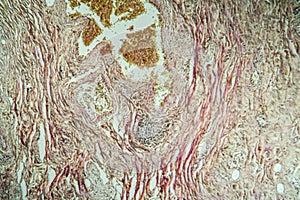 Colon tissue with diverticulum