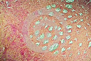 Colon tissue with diverticulum