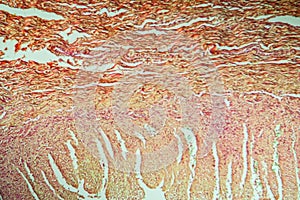 Colon tissue with diverticulum