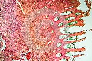 Colon tissue with diverticulum