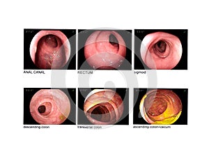 Colonoscopy Anal canal,rectum,sigmoid,descending colon,transverse colon. photo