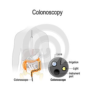 Colonoscopy in the colon. Silhouette of the man with the colon and close-up of endoscope