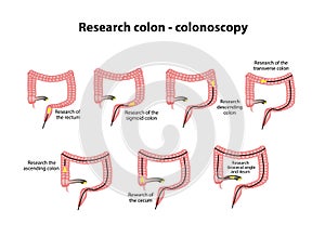 Colonoscopy. Diagnosis of the colon. Infographics. Vector illustration on background photo
