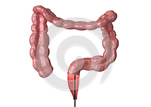 Colonoscopy - is the endoscopic examination of the large intestine and rectum that helps in the discovery of bowel cancer