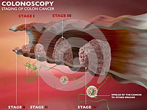 Colonoscopy examination colon digestive system photo