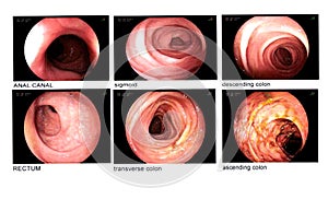 Colonoscopy image.Internal organs Anal canal,sigmoid,descendind colon,rectum,transverse colon,aseending colon is normal. photo