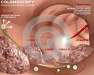 Colonoscopia a investigacion 