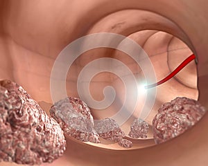 Colonoscopy and probe