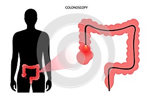 Colonoscopy procedure concept