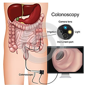 Colonoscopy procedure labeled 3d  diagram on white background