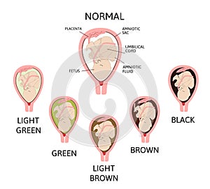 Color of amniotic fluid in the amniotic sac. normal and danger variants.