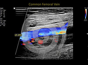 Color Doppler ultrasound determination in deep vein thrombosis patients for finding  deep vein thrombosis of lower extremity